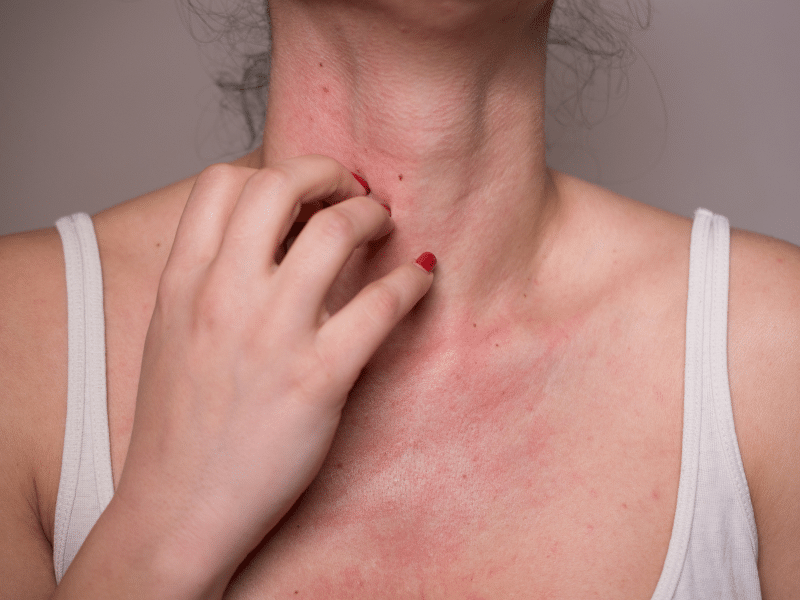 allergiás bőr